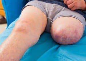 Eine schwere Körperverletzung kann zur Amputation eines Körperteils führen.